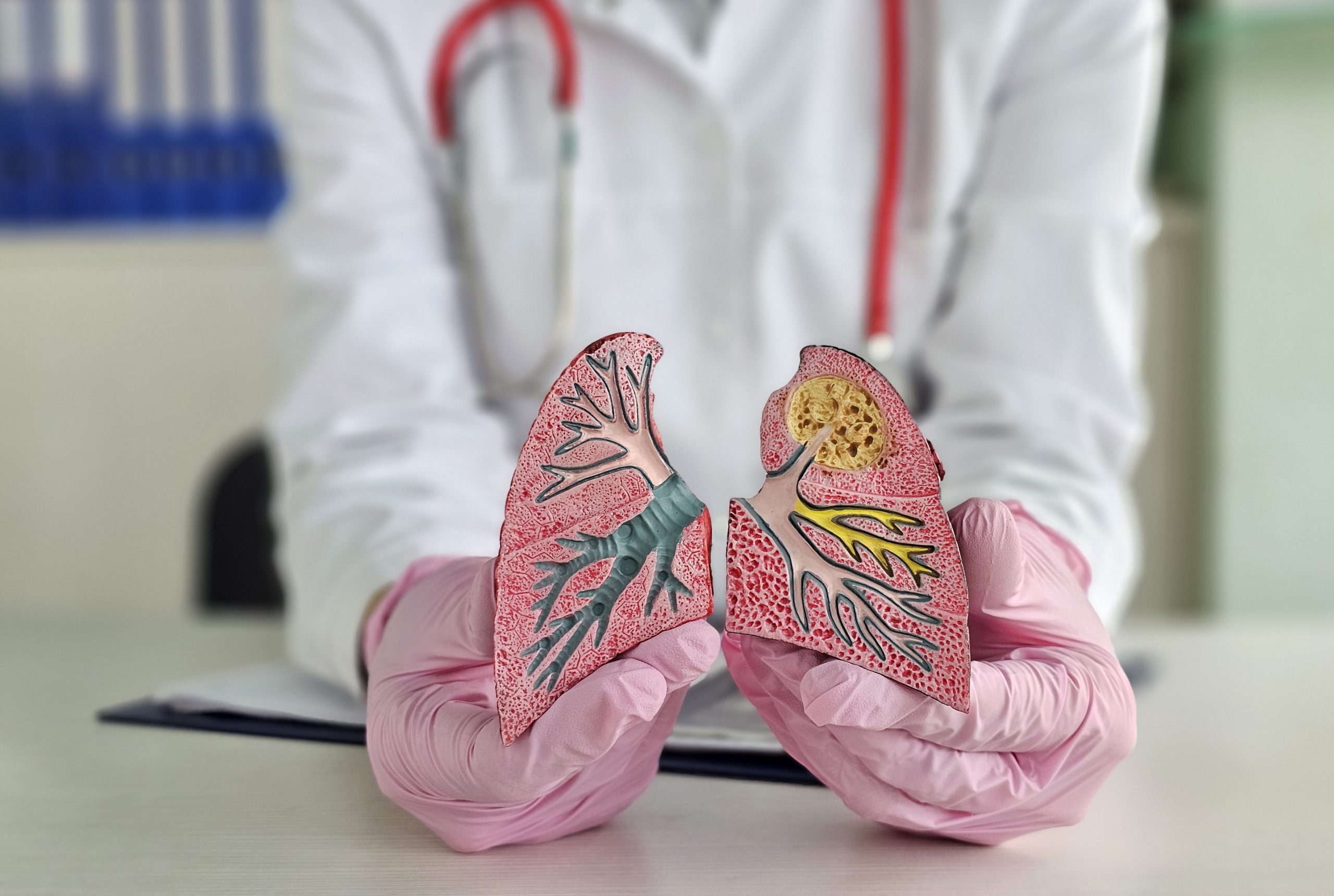 Comment vivre longtemps avec un cancer du poumon : explications et conseils