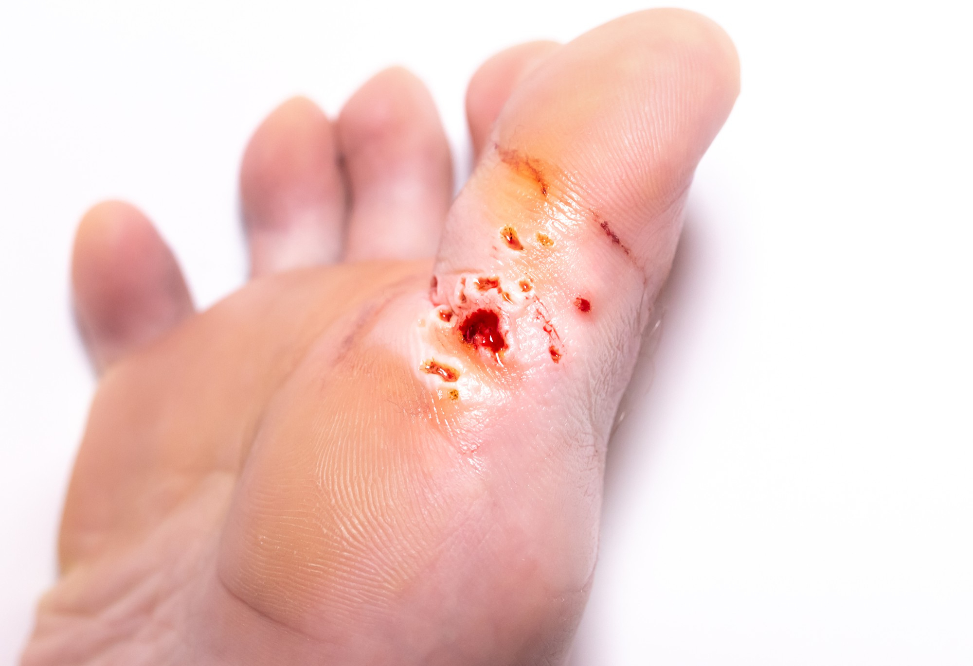 Une plaie qui ne cicatrise pas, quand s'inquieter